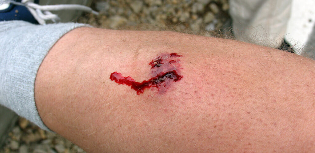 Dog Bite Attorney Frisco Tx