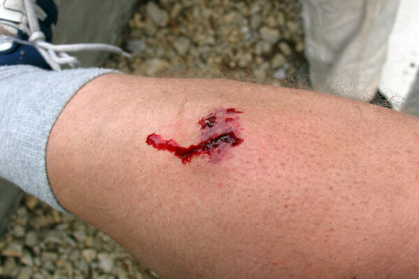 Dog Bite Attorney Frisco Tx