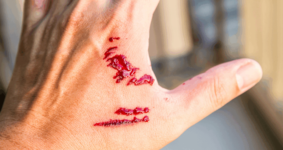 Bloody Dog Bite on the Hand